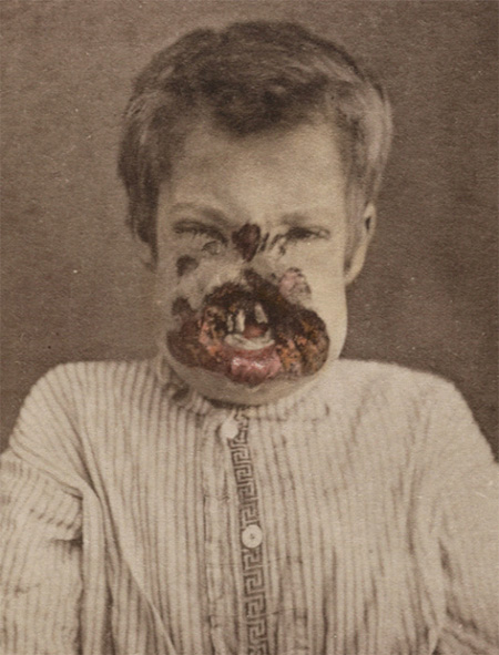 Syphilis AIDS pohlavní nemoci 02 Syphilis AIDS pohlavní nemoci 02